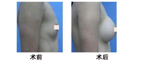 乳房再造的价格多少钱