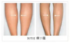 注射botox瘦小腿有风险吗_会不会留疤